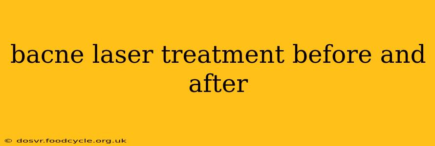 bacne laser treatment before and after