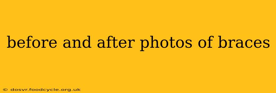 before and after photos of braces