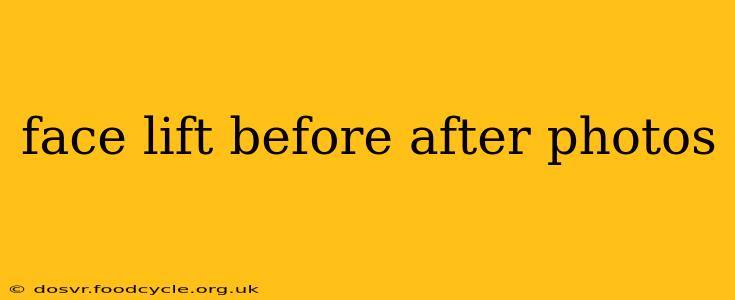 face lift before after photos