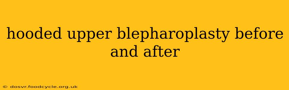 hooded upper blepharoplasty before and after