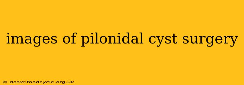images of pilonidal cyst surgery